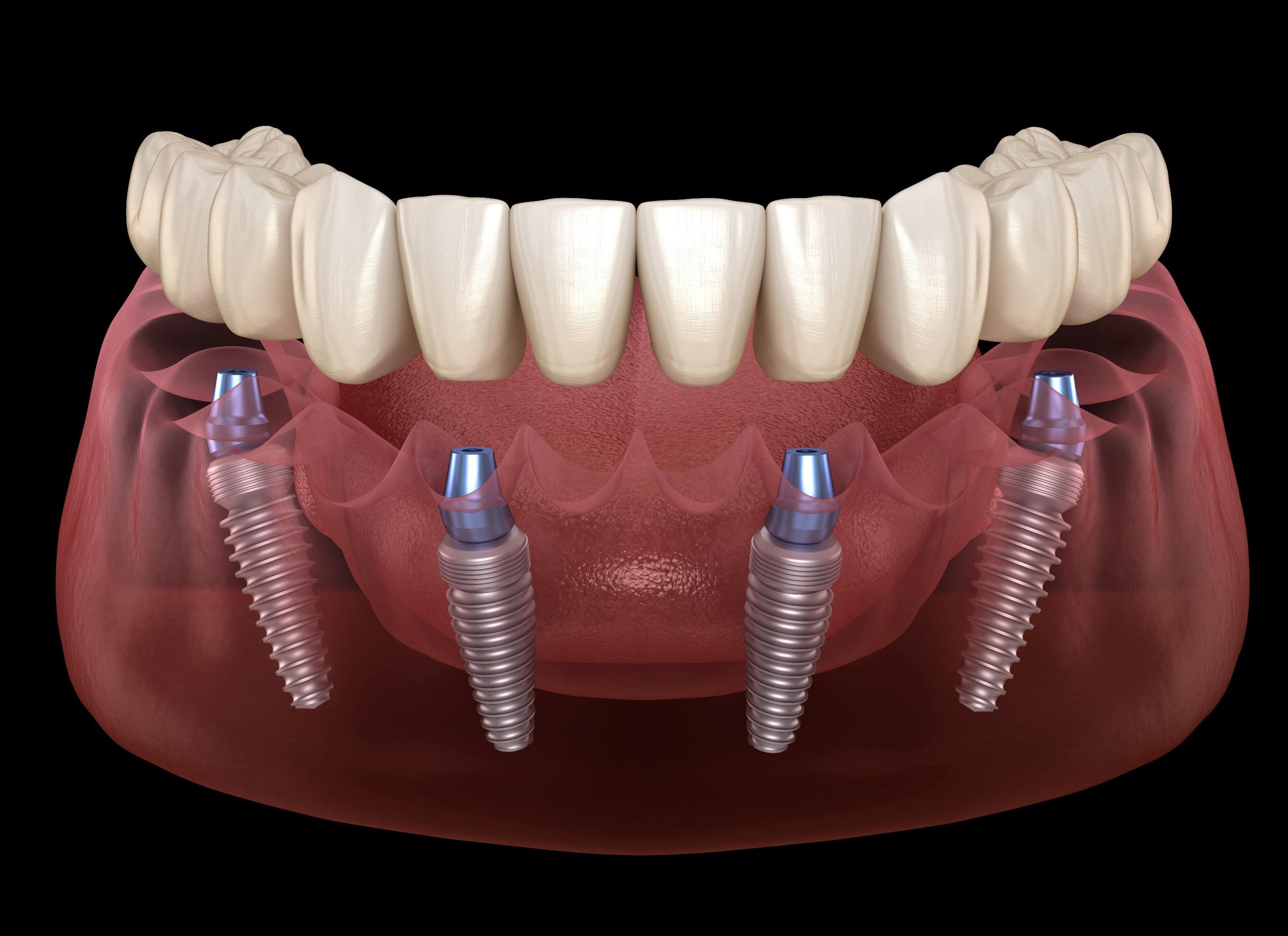 All On 4 Dental Implant - Concord, CA