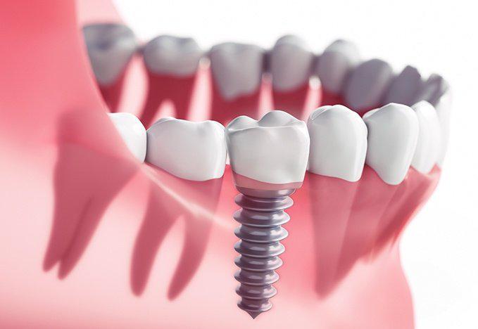 Concord California Dental Implant Specialist: Replace missing teeth