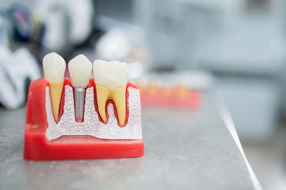 Dental implants in Concord